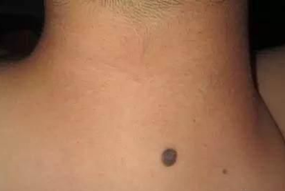 脖子后面有痣好嗎,脖子后面的苦情痣有什么說法 脖子后面有痣好嗎,脖子后面的苦情痣有什么說法